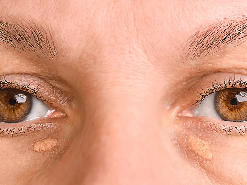 Plekjes, vlekjes en bultjes