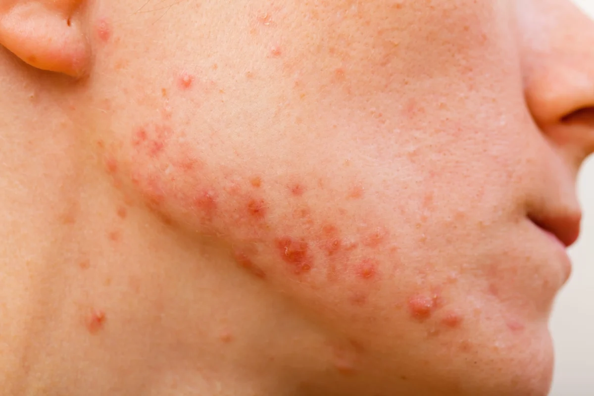 ACNE EN ZON, WORDT HET MINDER OF JUIST ERGER? DIT GEBEURT ER MET JE HUID